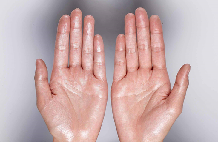 Cứ lo âu, căng thẳng là mồ hôi tay chảy thành giọt, vì sao?- Ảnh 1. Ra mồ hôi tay, chân quá nhiều gây khó chịu, ảnh hưởng đến sinh hoạt hằng ngày - Ảnh minh họa